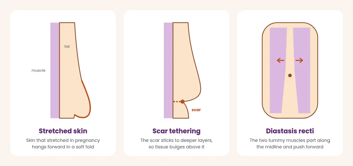 Three diagrams comparing the causes of a C-section shelf: stretched skin, scar tethering and diastasis recti