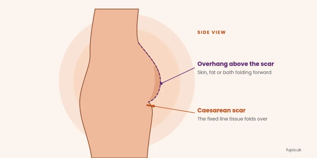 Side view illustration of a FUPA after a C-section, showing tissue folding forward over the caesarean scar