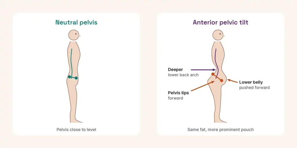 Side-by-side diagram of a neutral pelvis and anterior pelvic tilt, showing the pelvis tipped forward, a deeper lower back arch and the lower belly pushed forward