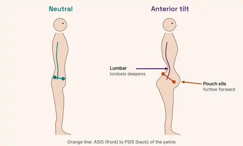 Side-view diagram comparing a neutral pelvis with anterior pelvic tilt, showing the pubic area tipped forward, a deeper lower back arch and the lower belly pushed out