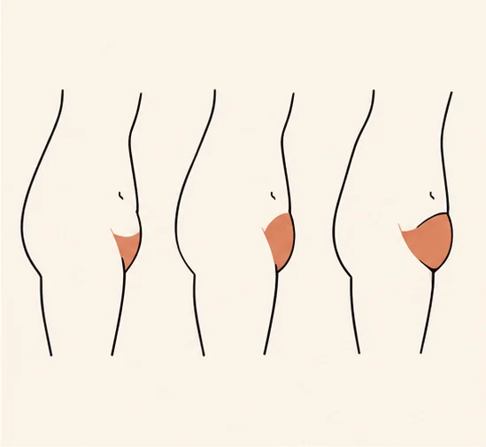 Three side profiles illustrating how a FUPA ranges from a gentle fullness to a distinctly rounded mound
