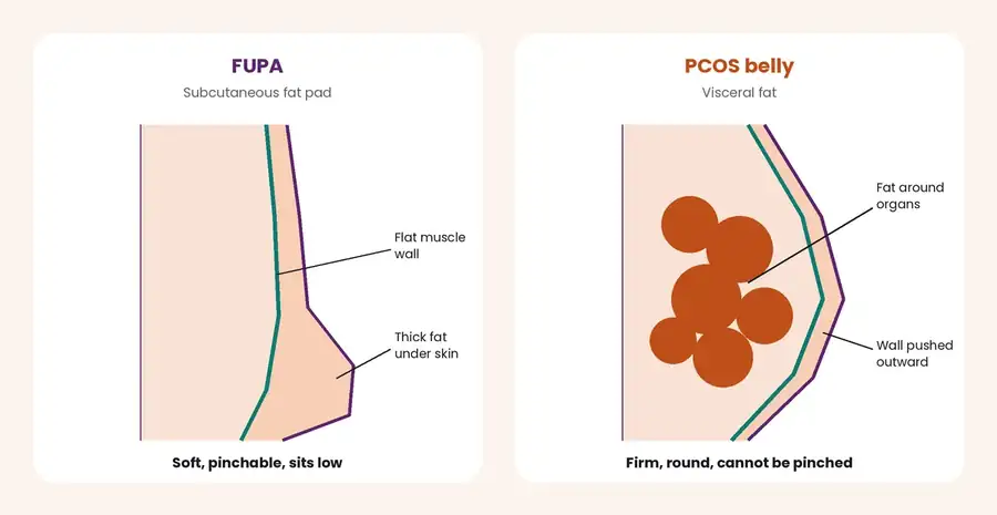 Side-view cross-sections comparing a FUPA, a pinchable subcutaneous fat pad, with a PCOS belly caused by visceral fat around the organs