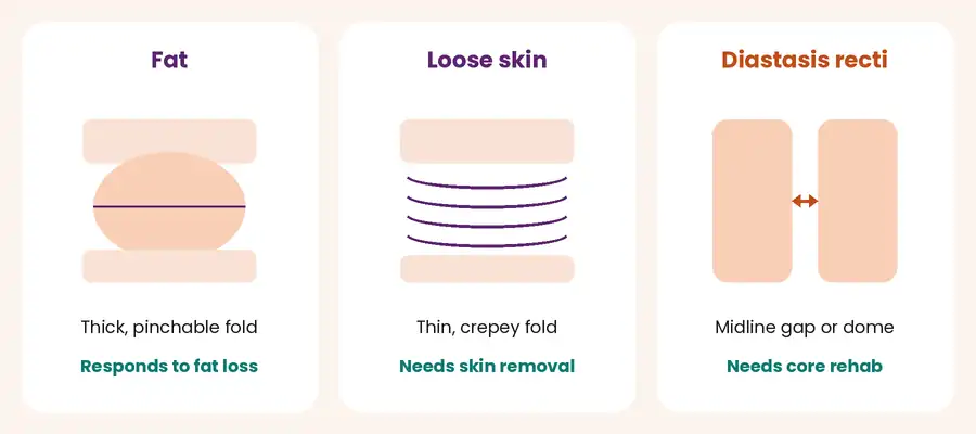 Three panels comparing a postpartum FUPA caused by fat, loose skin or diastasis recti, with the quick self-check for each