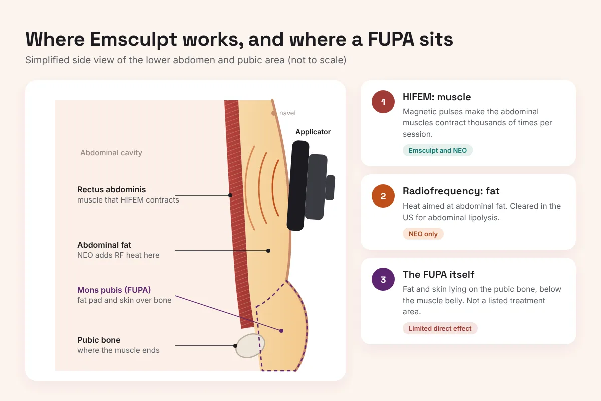 Side-view diagram of the lower abdomen showing an Emsculpt applicator over the rectus abdominis muscle, with the mons pubis fat pad sitting below it on the pubic bone