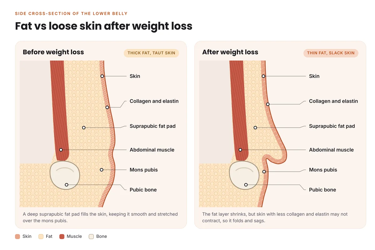 Diagram comparing the suprapubic fat pad and skin before and after weight loss, showing loose skin over a thinner fat layer