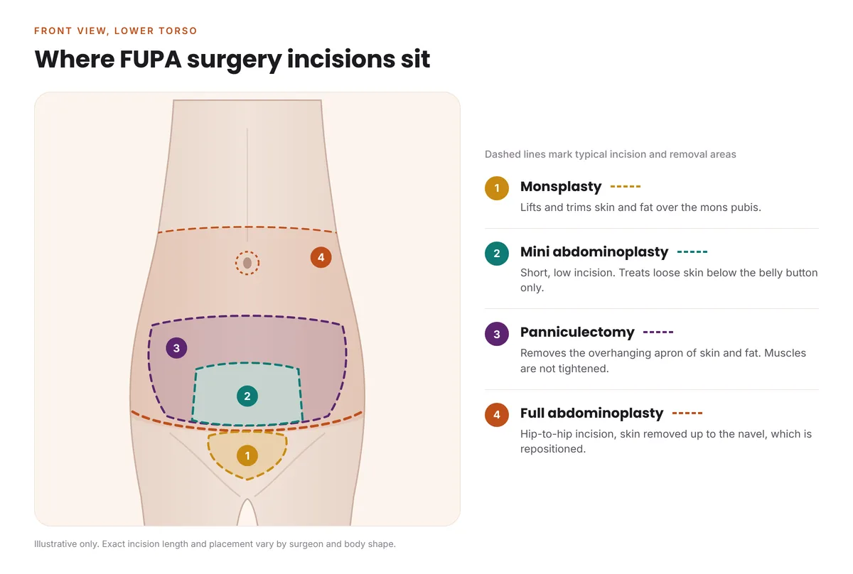 Diagram of incision areas for monsplasty, mini abdominoplasty, full abdominoplasty and panniculectomy
