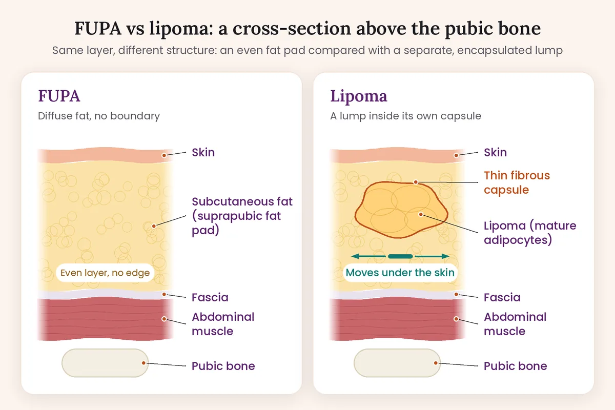 Cross-section diagram comparing a FUPA, a diffuse suprapubic fat pad, with a lipoma enclosed in a thin fibrous capsule in the subcutaneous layer