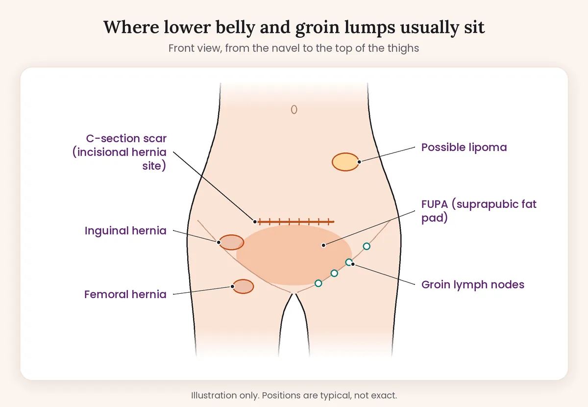 Labelled diagram of the lower abdomen showing where a FUPA, a lipoma, an inguinal hernia, a femoral hernia and groin lymph nodes usually sit