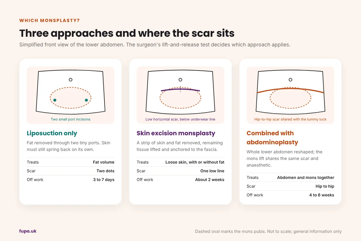 Diagram of three monsplasty approaches on a simplified lower abdomen outline: liposuction only with two small port incisions, skin excision monsplasty with one low horizontal scar, and a combined abdominoplasty with a hip-to-hip scar